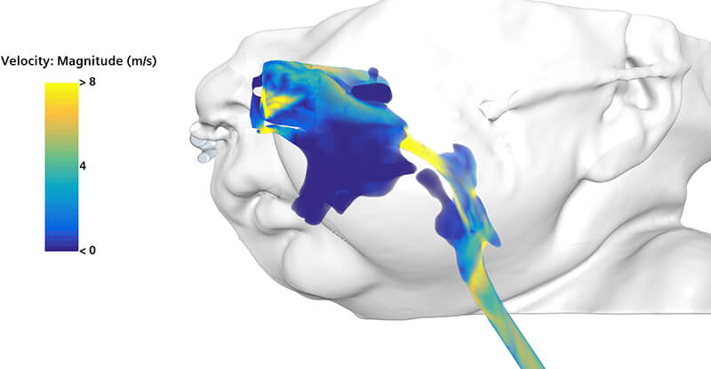 Flow modeling visuals developed and processed by Seattle Children’s Custom Care team depict large inspiratory pressure gradients and airflow jets, aiding in the identification of Milo’s early airway obstruction caused by Robin sequence