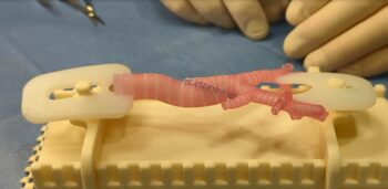 3-D printed airway model created in Seattle Children’s Innovation Lab