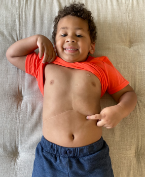 A boy shows off his surgery scar on his stomach