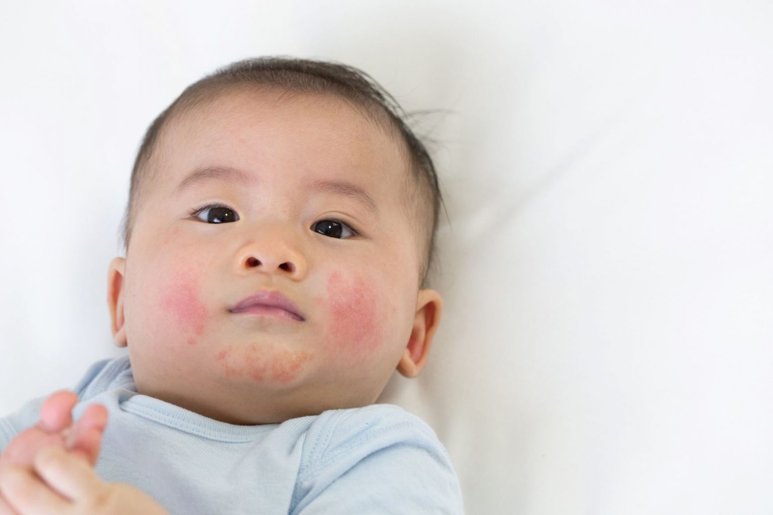 A baby with atopic dermatitis on their cheeks