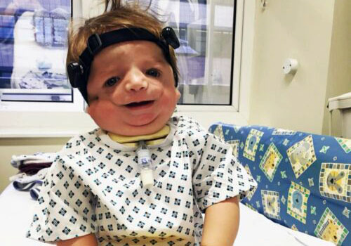 A boy with Treacher Collins syndrome in a hospital