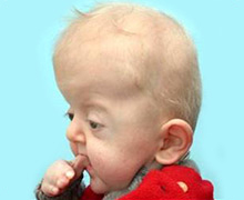 A baby with Apert Syndrome