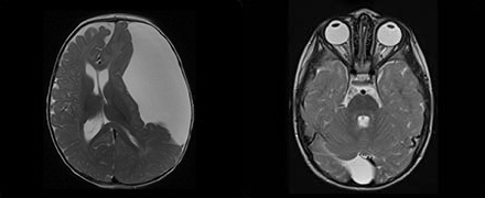 Teo scans of brains with arachnoid cysts