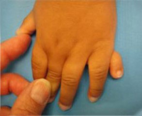 Child’s hand with some fingers joined and an extra finger on the outside of their little finger. 