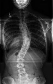 X-ray of a child from the head to the pelvis showing an S-shaped spinal curve