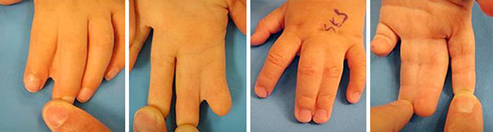 Four photos of children’s hands with webbed skin between fingers