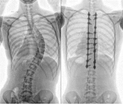 X-ray of a spine with scoliosis (left) and repaired (right)