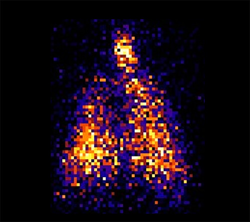 Scintigraphy image of radiolabeled aerosol showing medication deposition within lungs.