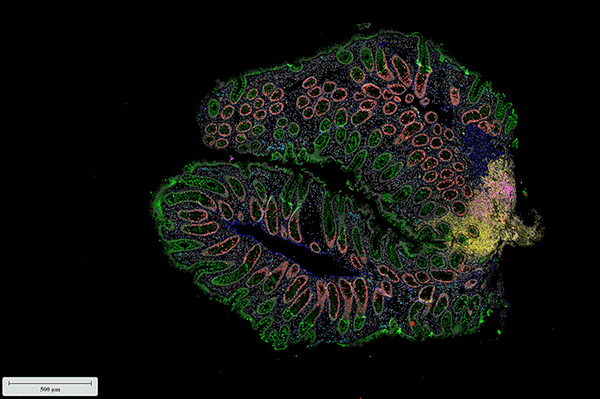 A piece of large intestine, biopsied from a pediatric IBD patient