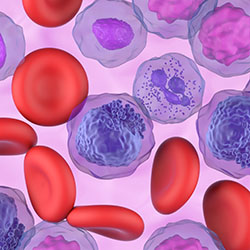 Graphic illustration of leukemia and blood cells 