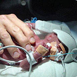 A premature infant receives breathing support from the Neonatal Respiratory Support Technologies Team